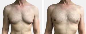 gynecomastia surgery in dubai abu dhabi